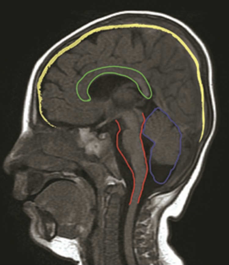 This image is an fMRI brain scan of a patient with the CLP1 mutation.