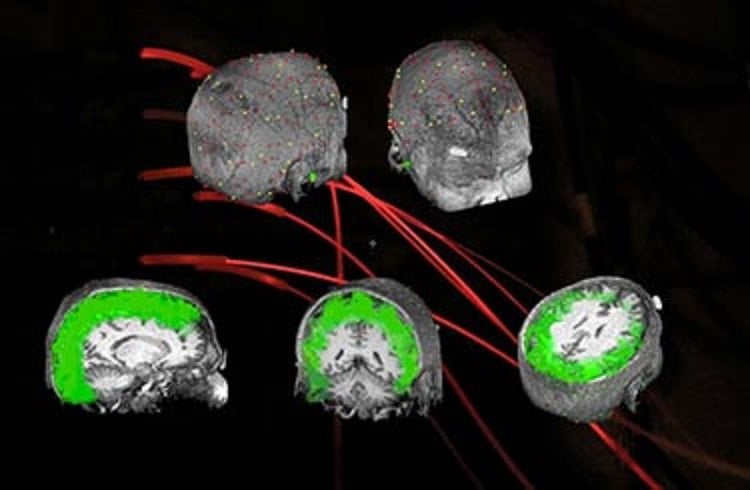 This image shos neuroimaging brain scans.