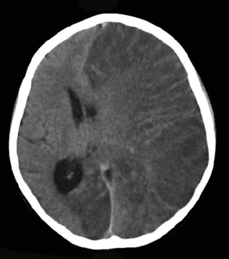 This is a CT scan of a patient with Rasmussen encephalitis.