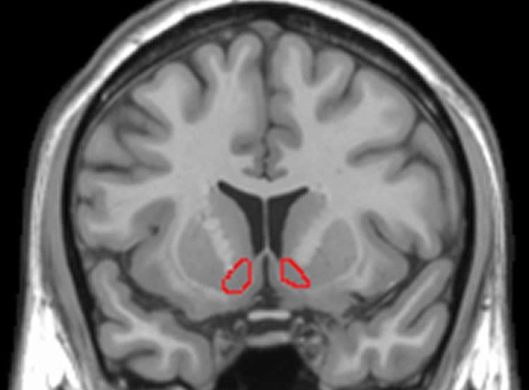 The image shows the location of the nucleus accumbens in the brain.