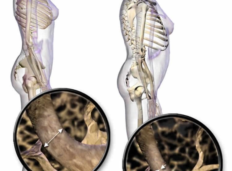 The image shows the differences between normal bones and those of people with osteoporosis.