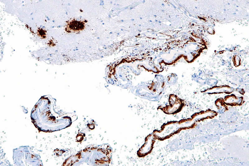 This image shows amyloid beta in senile plaques of the cerebral cortex.