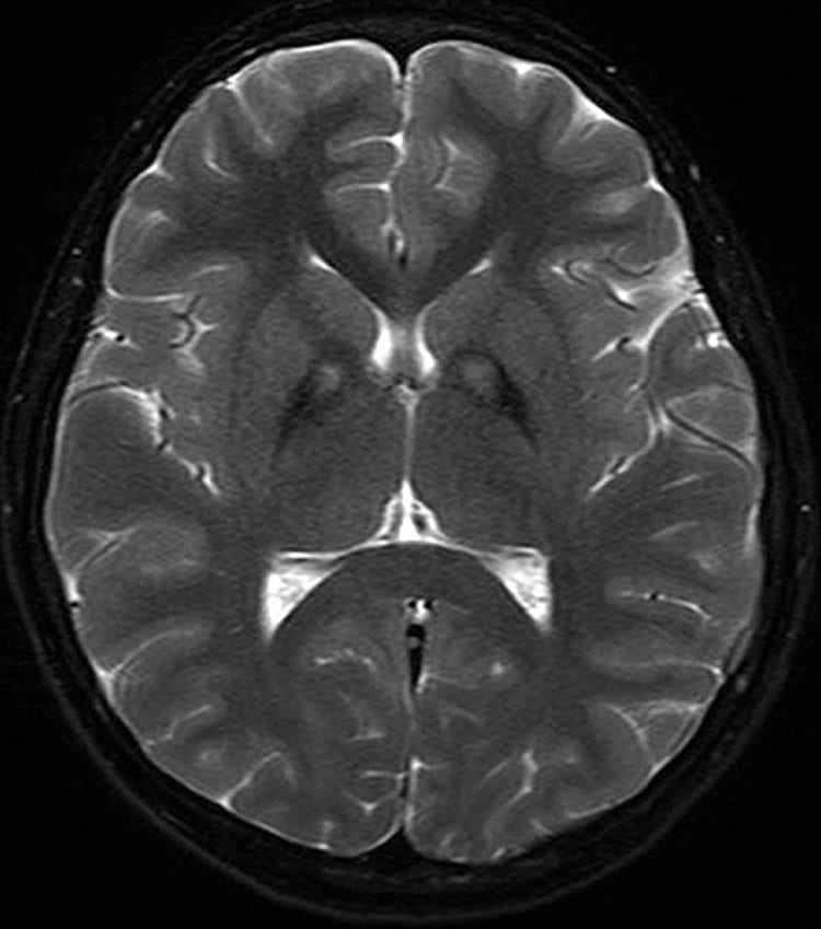 The basal ganglia can be seen as the two darker spots in this image.