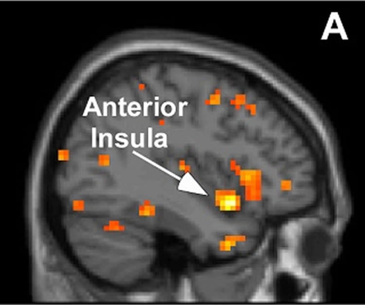 The image shows an fMRI scan wityh the Anterior Insula highlighted and labeled.