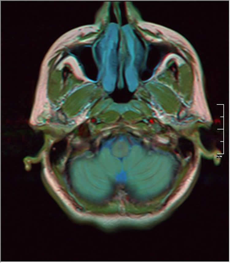 This image shows an MRI scan of a person with a glioma brain tumor.