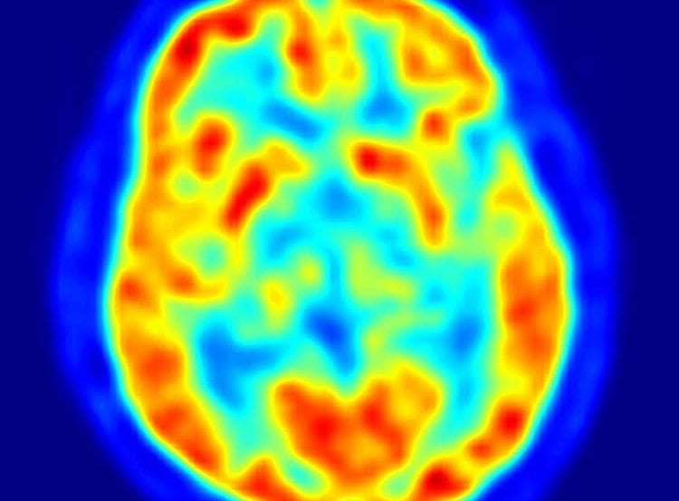 The image shows a PET scan of the human brain.