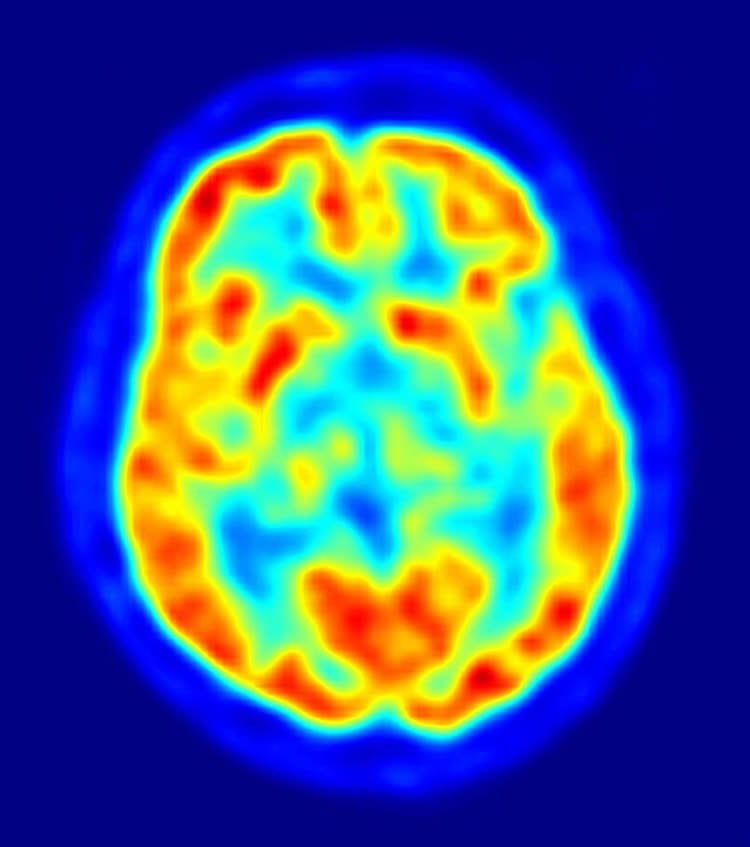 The image shows a PET scan of the human brain.