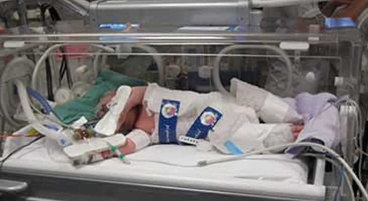 The image shows a new born baby being cooled in an incubator.