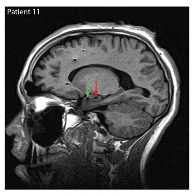 The image shows and mri of the brain with arrows pointing to the amygdala.