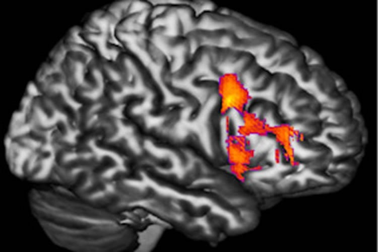 The image shows an mri scan with the dorsal frontal cortex lit up in a bipolar patient.