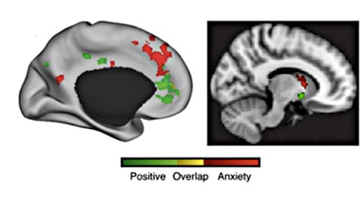 The image shows an mri scan with the prefrontal corext and striatum highlighted.