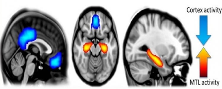 The image shows a scan which details brain activity under psilocybin.