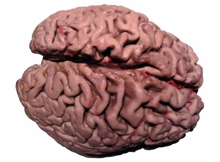 This image shows a shows a plastinated brain of an Alzheimer's patient.