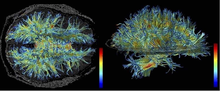 This image shows is an MRI of white matter in the human brain.