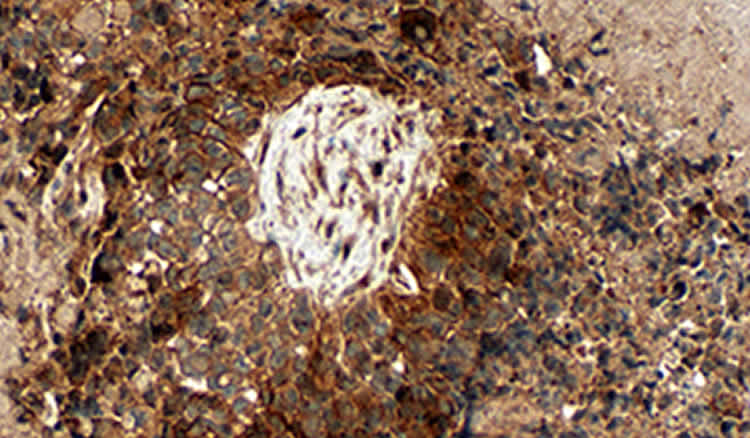 The image shows a glioblastoma brain tumor under a microscope.