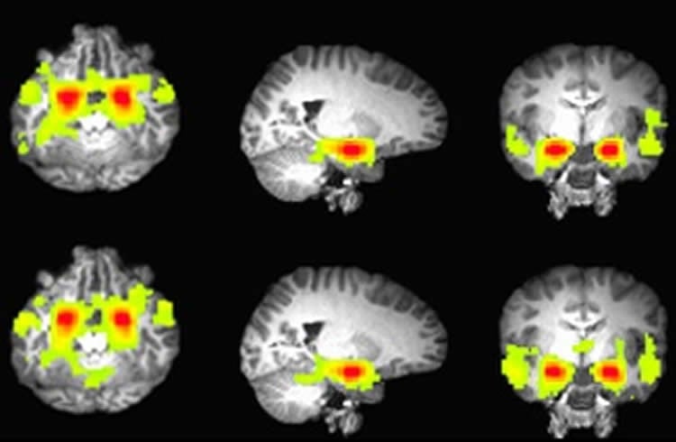 The image shows fMRI scans wiht the amygdala and prefrontal cortex highlighted in yellow.