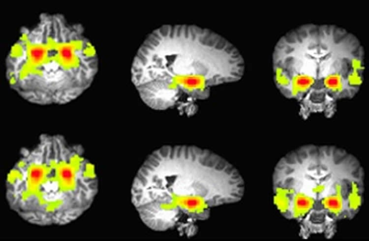 brain fmri scan