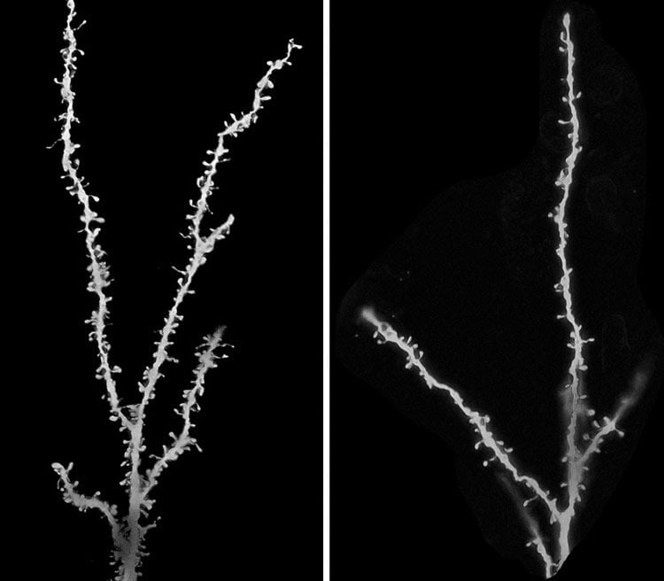 The image shows neurons from a control brain and a brain of a person with autism.