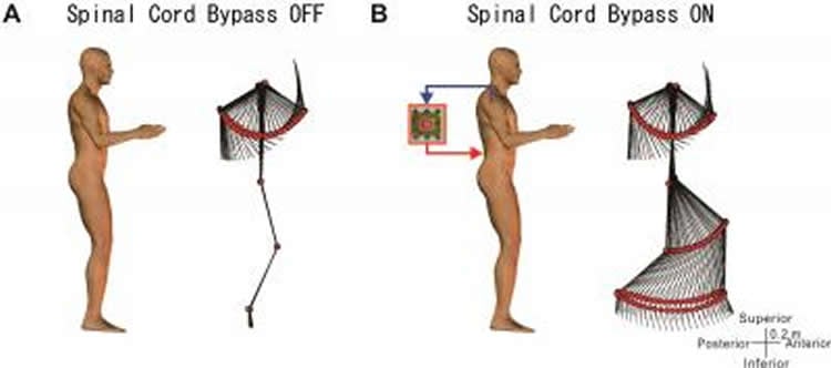 The image is a diagram of a person with the spinal cord bypass switched off and on.