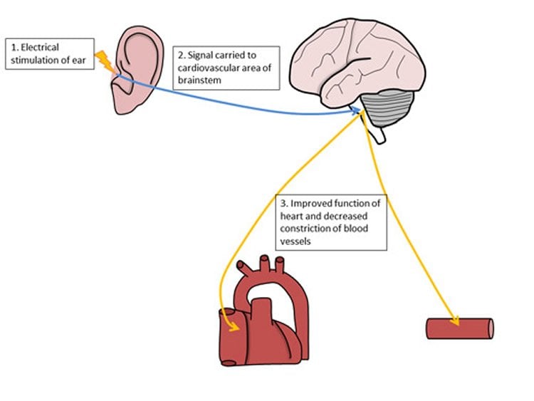 This image is a diagram showing how the electrical stimulation of the ear is carried to the CV area of the brain and down to the heart.