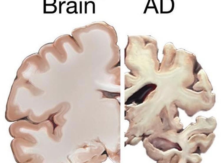 This image shows brain slice from a healthy brain and one from a brain affected by alzheimer's disease.
