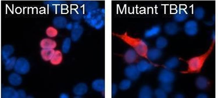 The image shows TBR1 mutations in autistic children.