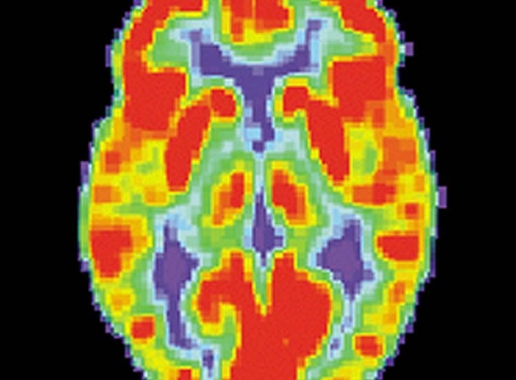 The image shows a PET scan of a normal brain.