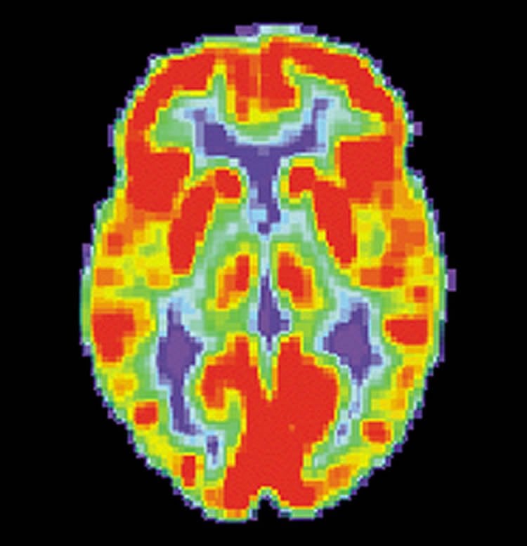 The image shows a PET scan of a normal brain.