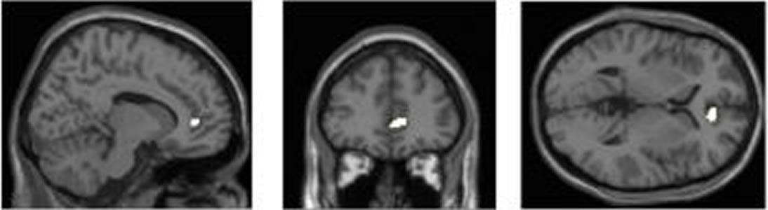 This image shows MRI scans of the ACC.
