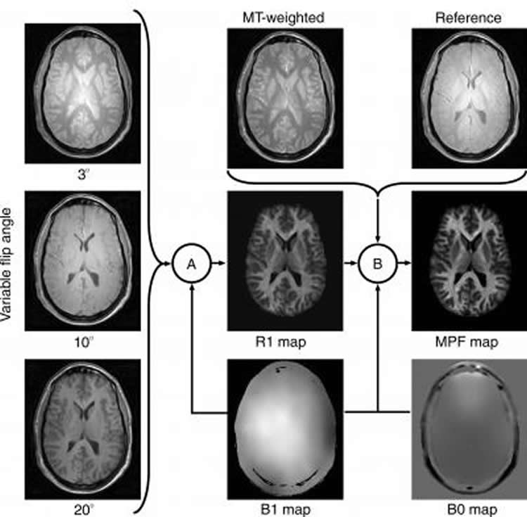 The image shows a range of MRI brain scans.