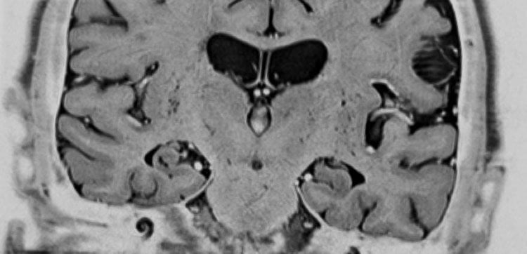 This image shows a coronal view of the hippocampus brain region of a patient with Alzheimer’s.