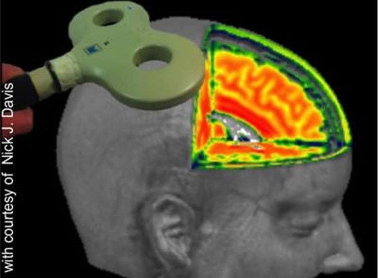 This image shows the skull with a neuroimaging brain cutout. Above the skull is a TMS machine.