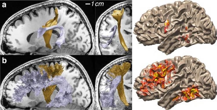 The image shows mri scans mapping the white matter in a human brain.