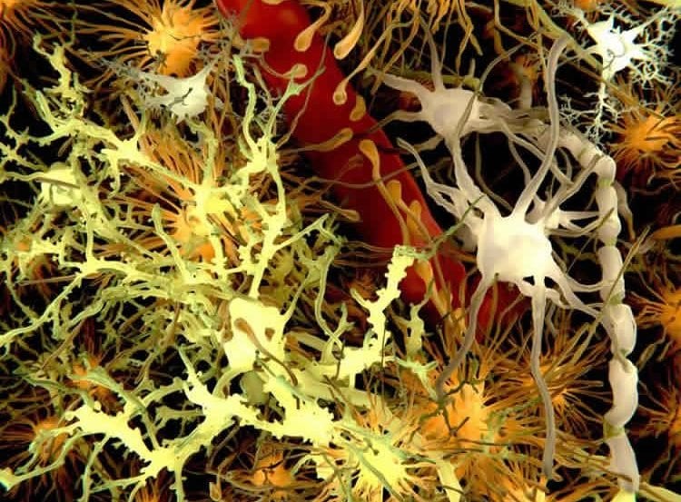 This image shows a microscopic view of neurons and amyloid plaques in the brain.