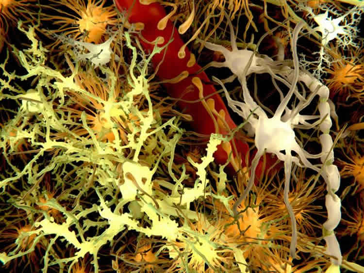 This image shows a microscopic view of neurons and amyloid plaques in the brain.