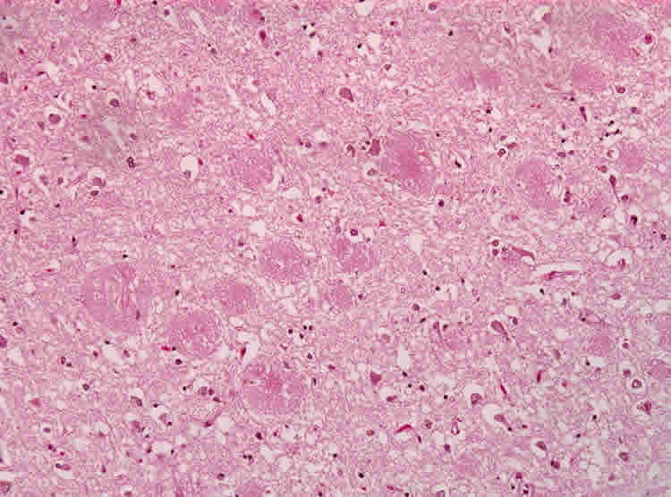 This image shows amyloid plaques associated with alzheimer disease from an HE stained brain slice.