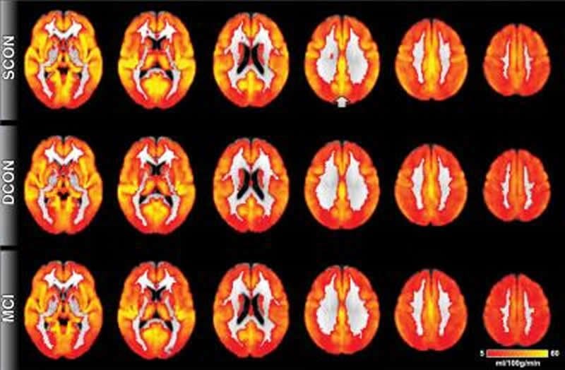 This image shows MRI brain perfusion scans.