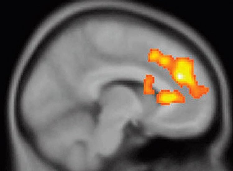 This image shows a PET scan with changes in the dorsal anterior cingulate cortex.