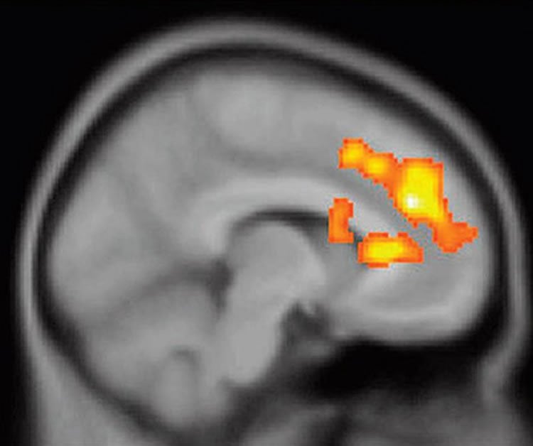 This image shows a PET scan with changes in the dorsal anterior cingulate cortex.