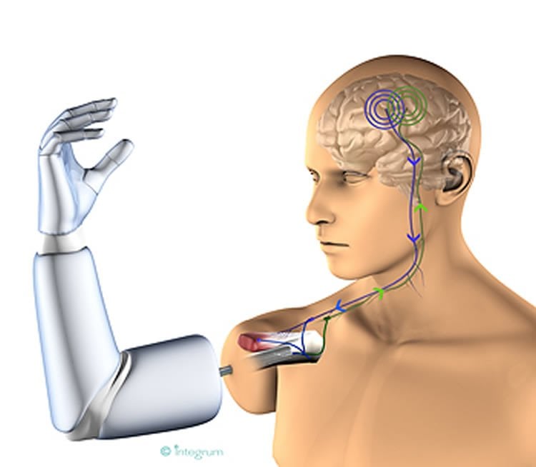 mind controlled bionic arm