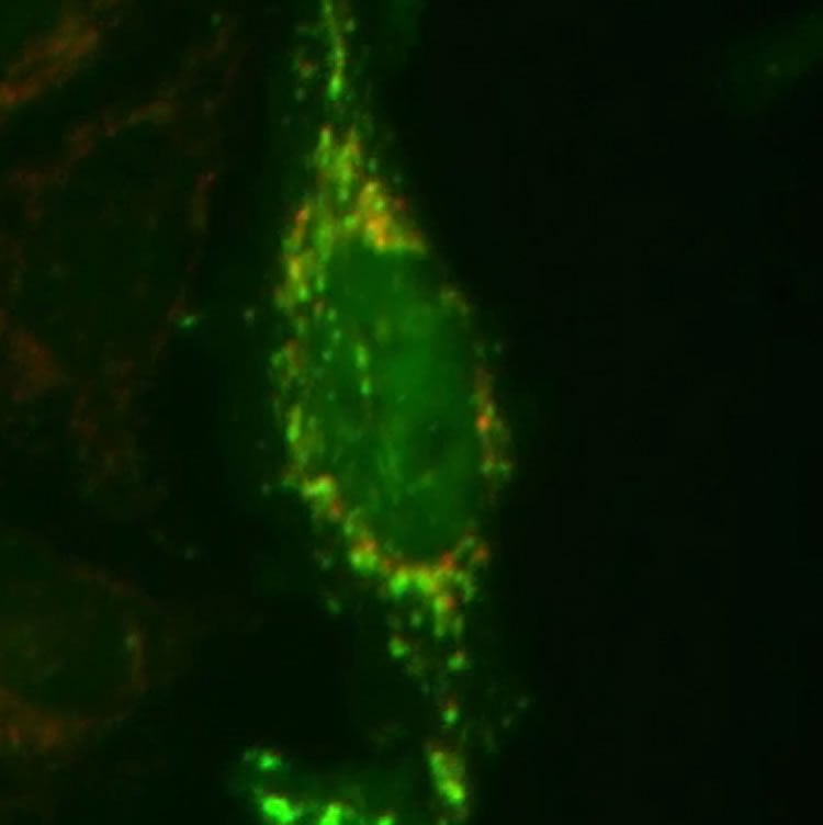 This image shows the damage to mitochondria caused by Parkin.