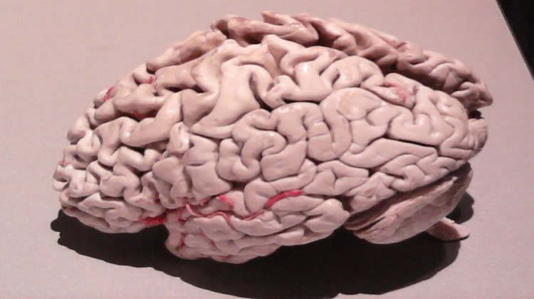 This image shows a plastinated alzheimer's brain.