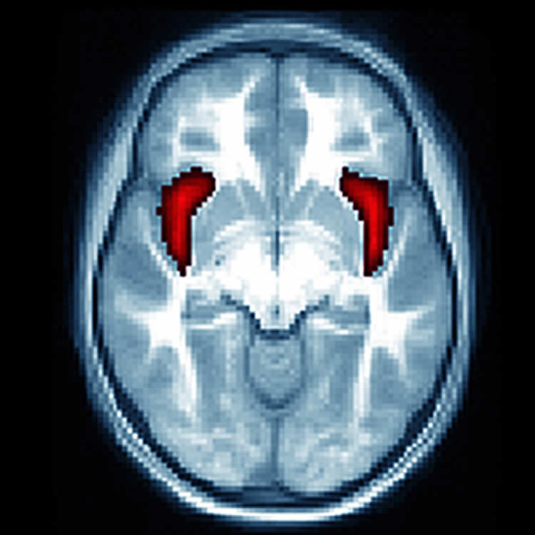 This image shows the location of the anterior insular in a brain scan.