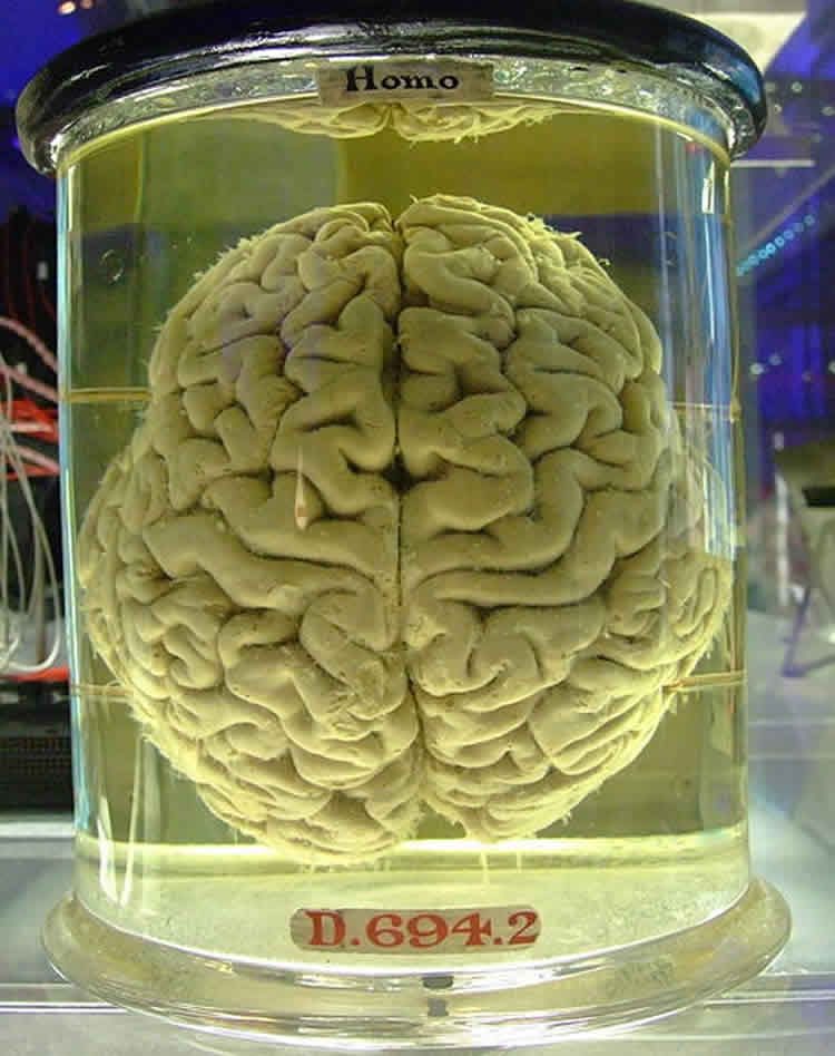 This image shows a human brain in a jar.