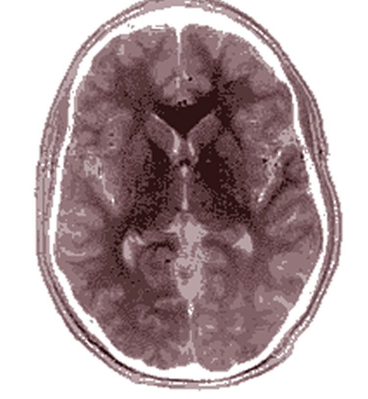 This image shows an MRI brain scan.