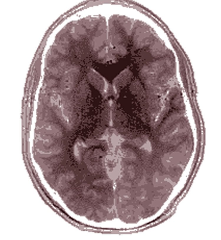 mri brain scan anatomy