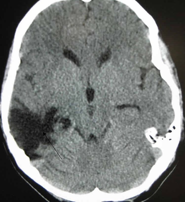 This image shows a CT of the head years after a traumatic brain injury showing an empty space where the damage occurred.