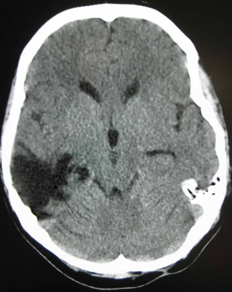 This image shows a CT of the head years after a traumatic brain injury showing an empty space where the damage occurred.