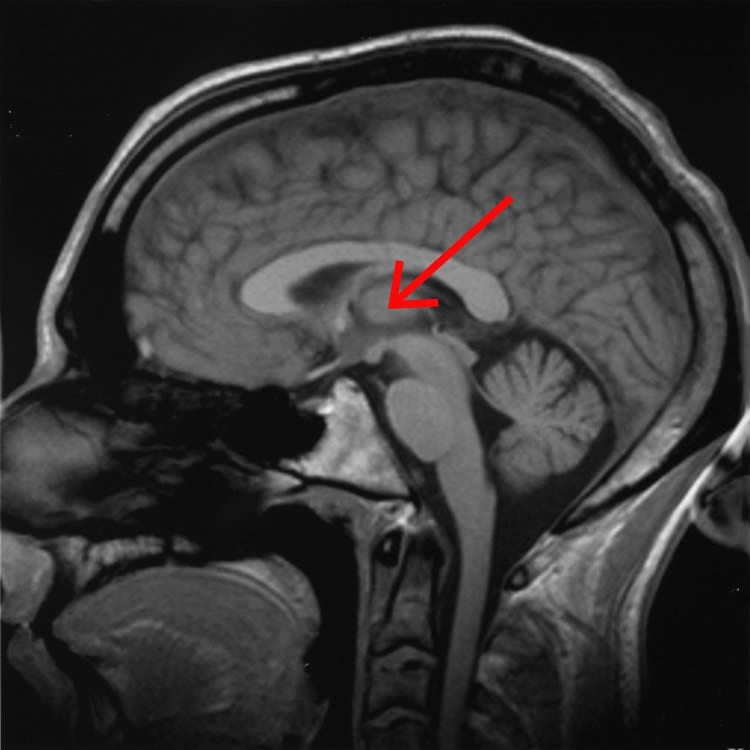 This image shows the location of the thalamus in the human brain.