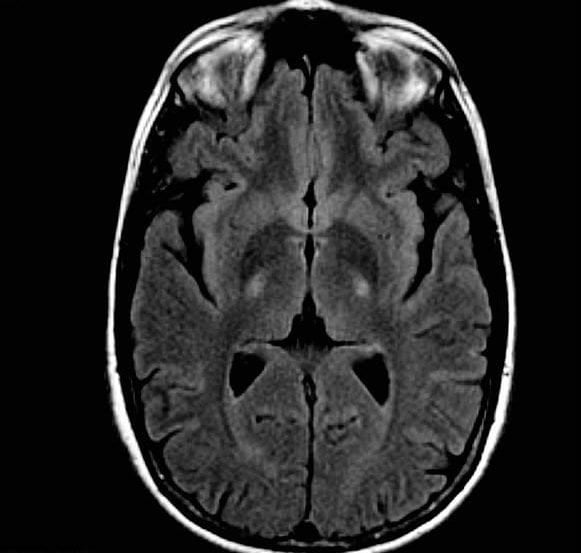 The image shows an MRI brain scan of a person with ALS.